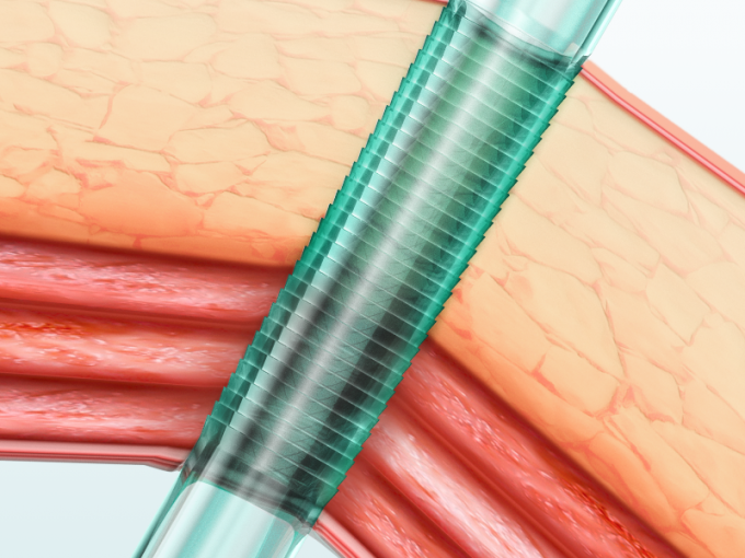 निष्फल एकमुश्त ऑप्टिकल ट्रोकर और लैप्रोस्कोपी सर्जरी के लिए कैन्यूल एकल रोगी 0