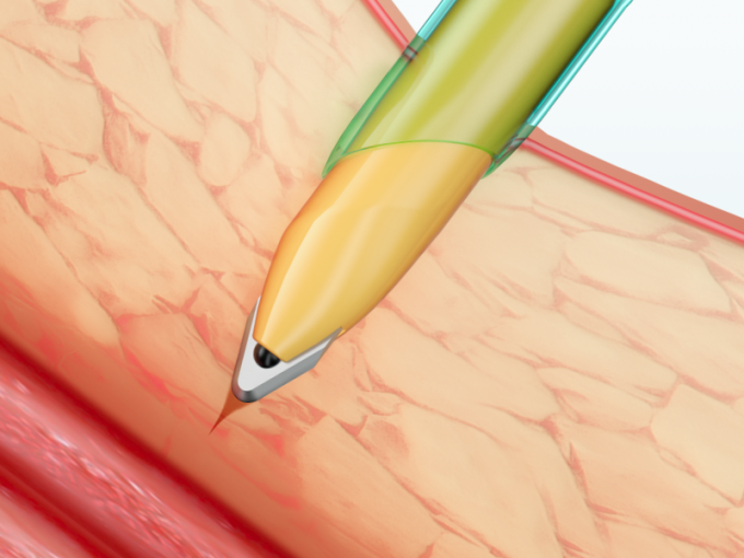 ब्लेड के साथ लैप्रोस्कोपिक उपकरण डिस्पोजेबल ट्रोकार प्रवेशनी 1