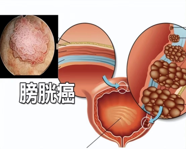 के बारे में नवीनतम कंपनी की खबर मूत्राशय के कैंसर का नैदानिक निदान और शारीरिक देखभाल  0